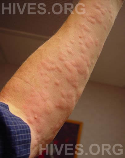 Hives Pictures Photographs Of Hives On Arms Legs Face Hands Feet 