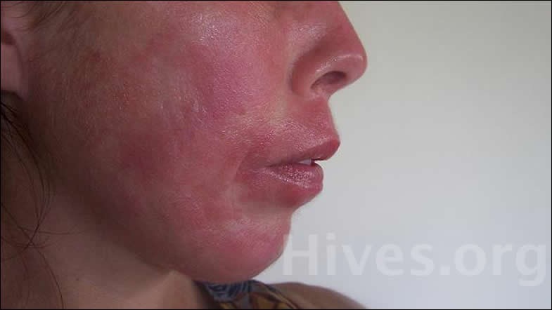 Sudden Face Rash Pictures Photos