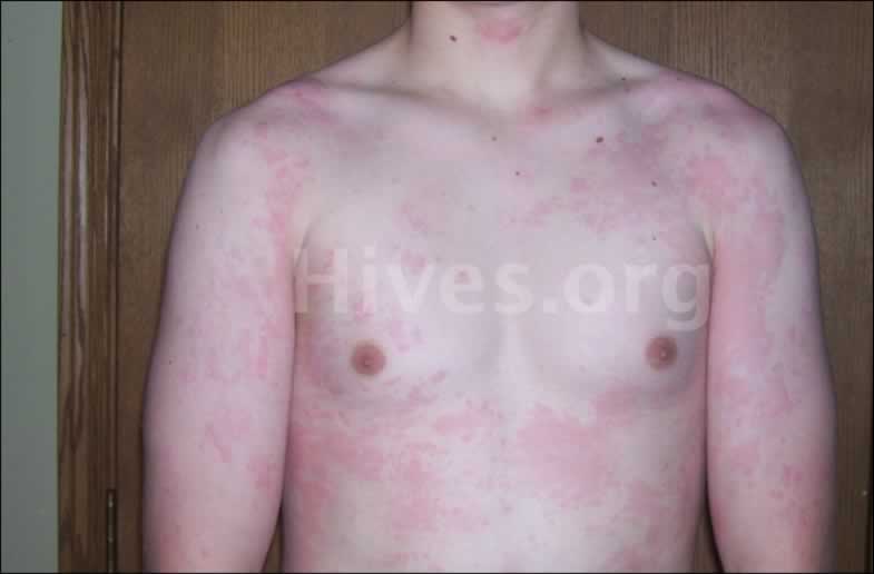 What are hives? What is urticaria? What causes hives ...