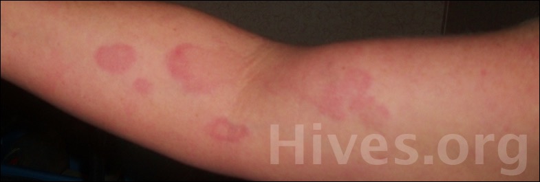 Hives Treatment, Causes, Home Remedies & Pictures